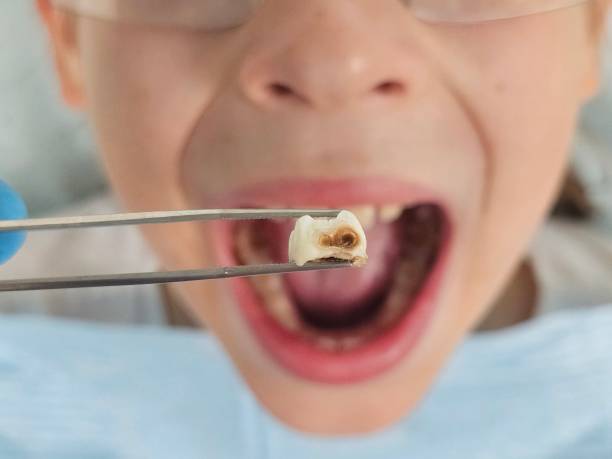 Best Emergency Wisdom Teeth Removal in Woodway, TX